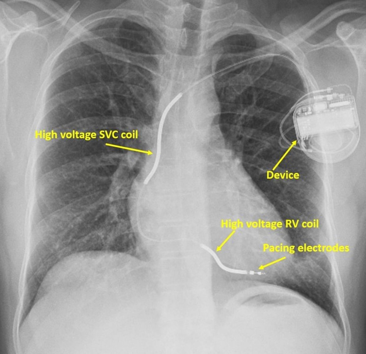 X-ray of a person with ICD, showing high voltage shocking coils and pacing electrodes