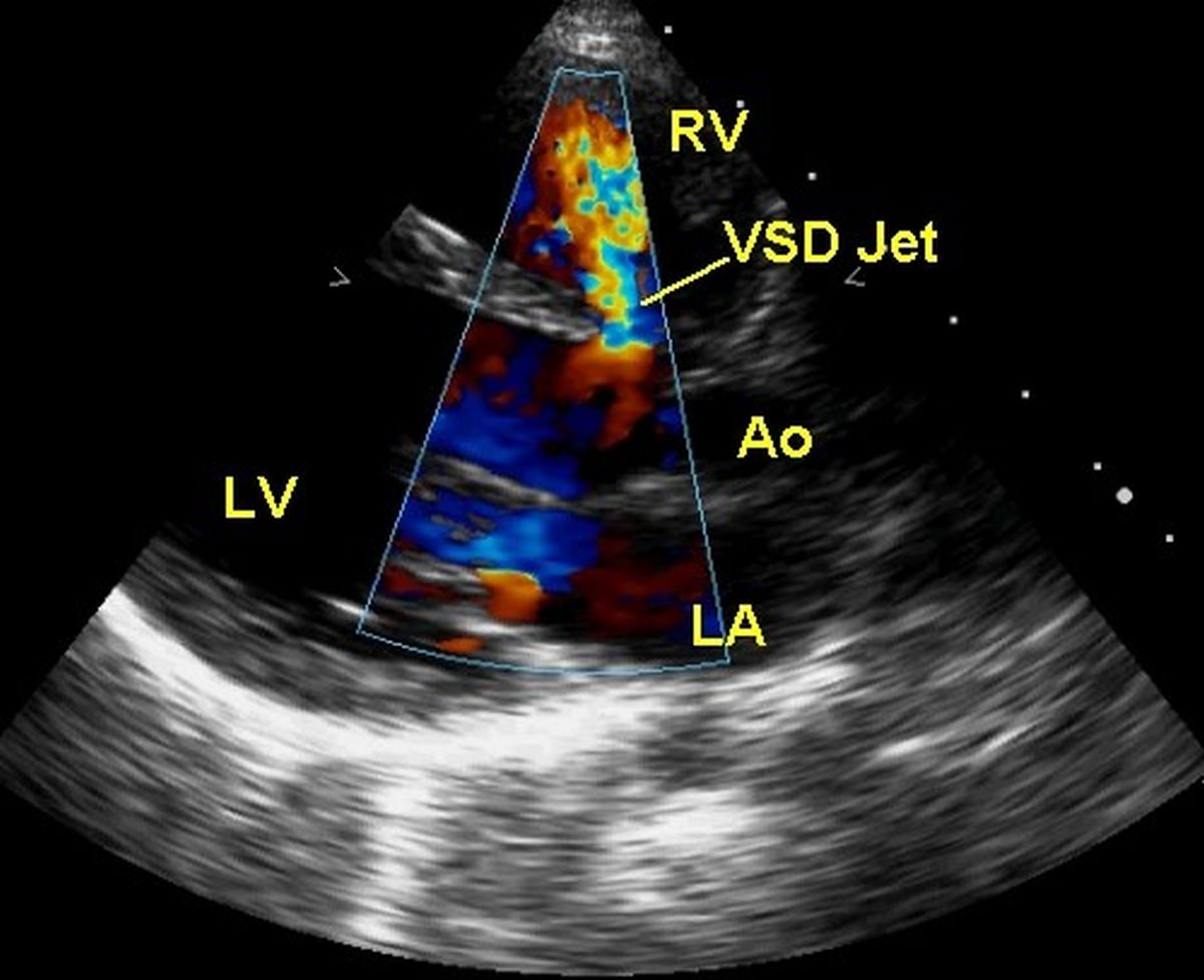 Colour Doppler echocardiogram showing colour flow jet across a perimembranous VSD
