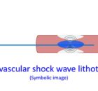 Intravascular shock wave lithotripsy