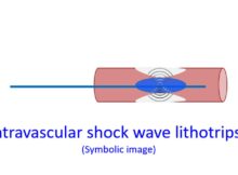 Intravascular shock wave lithotripsy