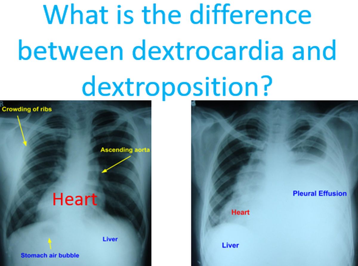 What is the difference between dextrocardia and dextroposition