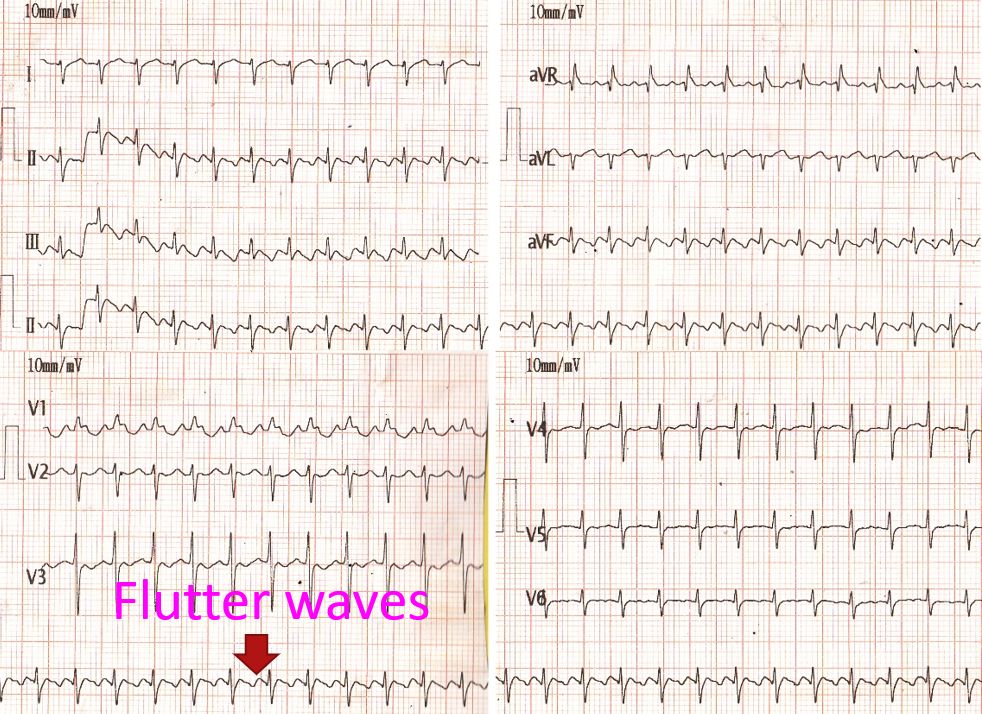 Atrial flutter at above 400 per minute in a new born baby