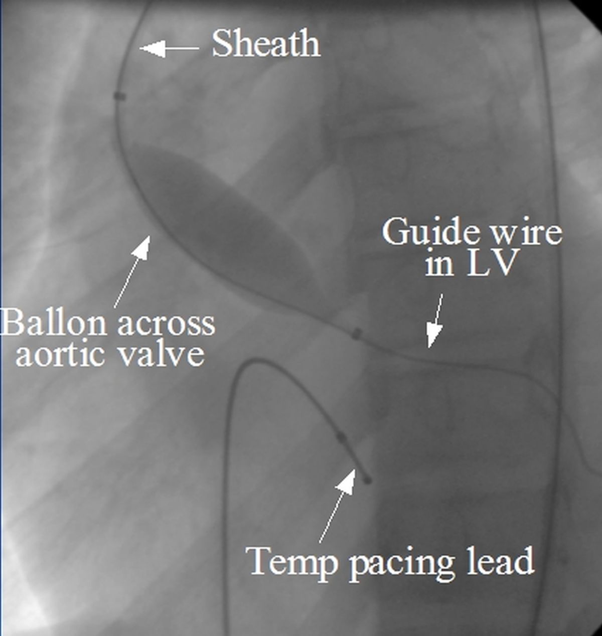 Balloon aortic valvuloplasty