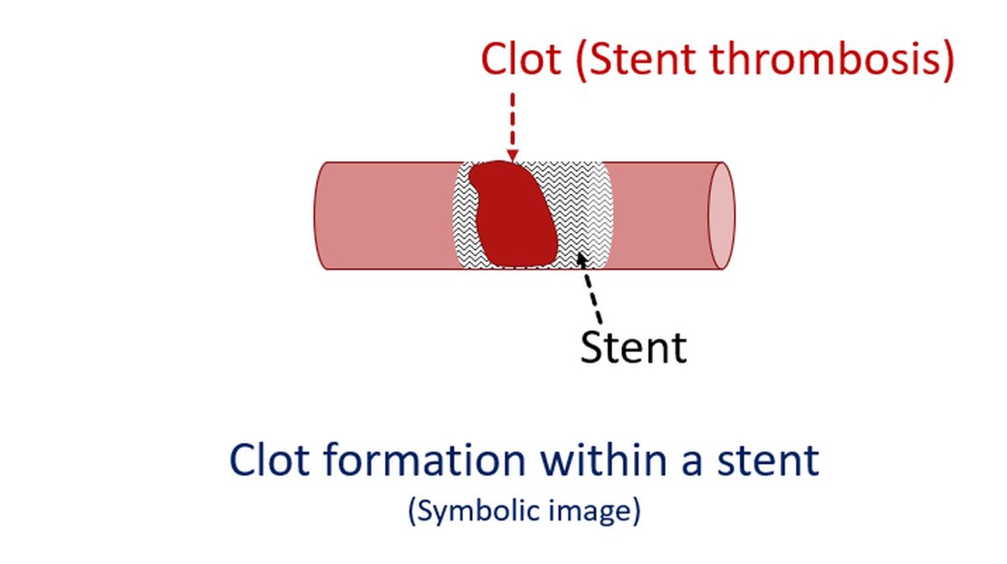 Clot formation within a stent (stent thrombosis)