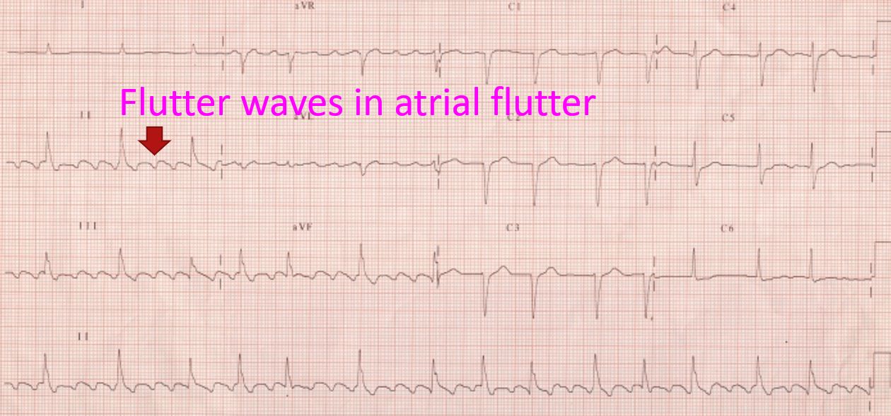 Flutter waves on ECG in atrial flutter