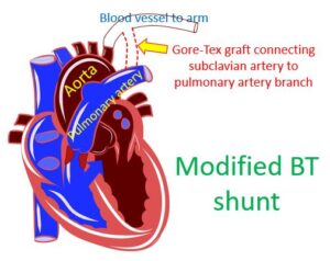 What Is Blalock – Taussig (BT Shunt) Operation? – All About Heart And ...