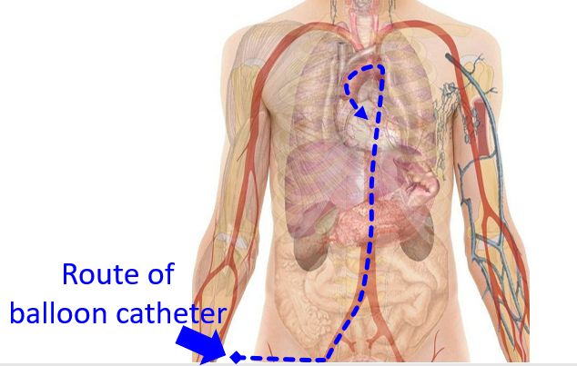Route of balloon catheter in balloon aortic valvuloplasty