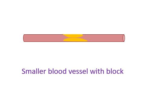 Smaller blood vessel with block