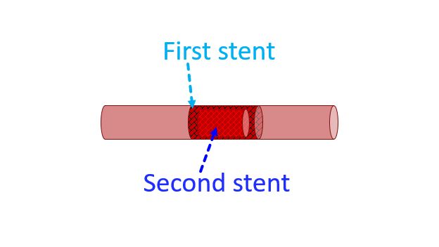 Stent within a stent