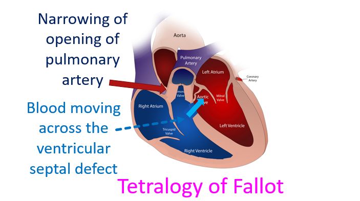 Tetralogy of Fallot with right to left shunt