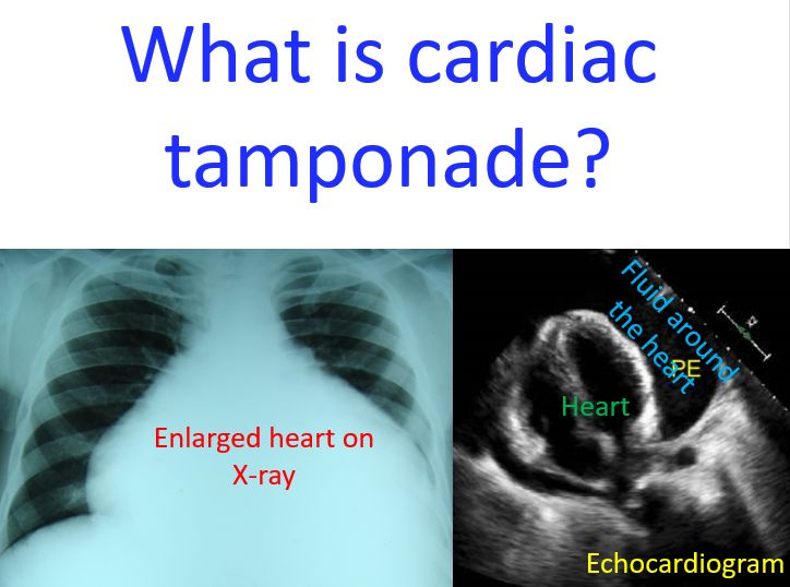X-ray and echocardiogram showing fluid collection around the heart