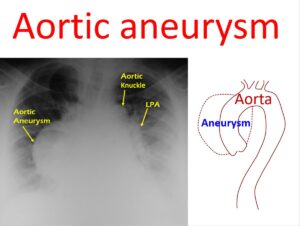 Aortic Aneurysm – All About Heart And Blood Vessels