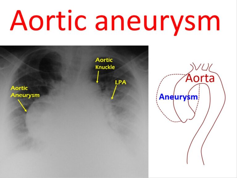 Aortic aneurysm – All About Heart And Blood Vessels