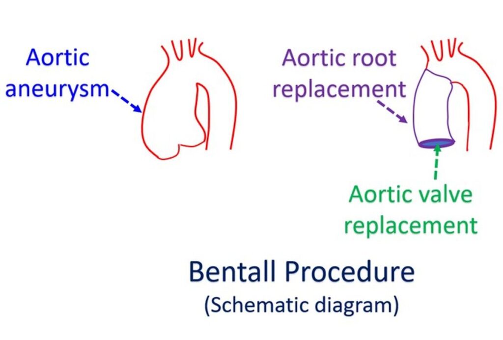 case study bentall procedure