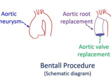 Bentall procedure - Schematic diagram