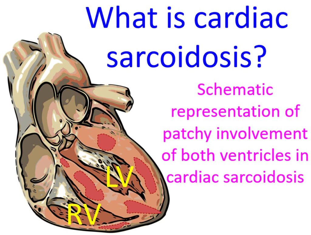 What Is Cardiac Sarcoidosis? – All About Heart And Blood Vessels