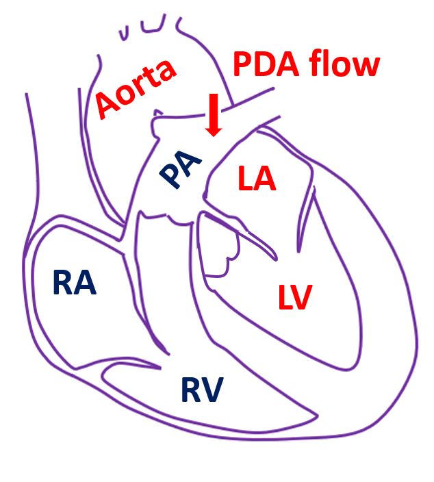 Patent ductus arteriosus (PDA)