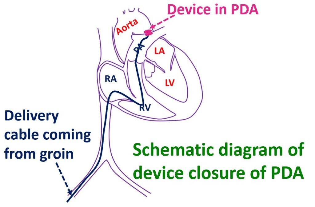 Device closure of PDA All About Heart And Blood Vessels