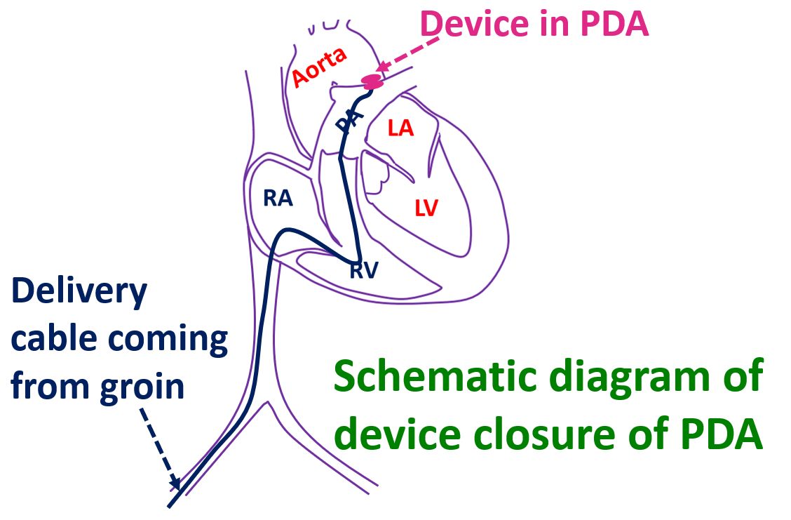 device-closure-of-pda-all-about-heart-and-blood-vessels