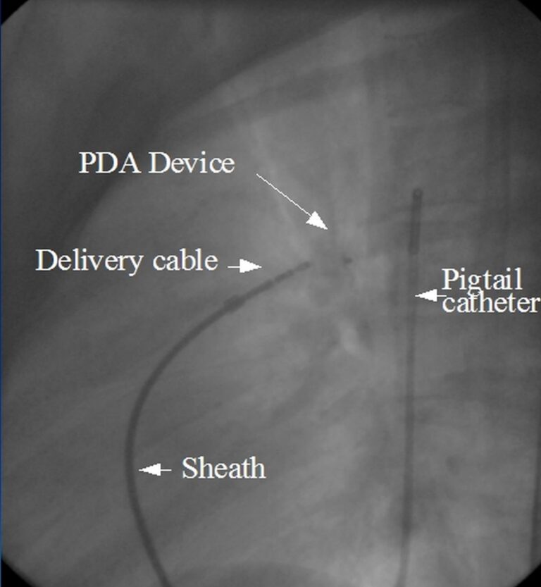 Device closure of PDA - All About Heart And Blood Vessels