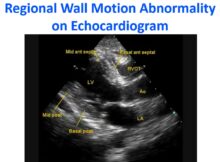 Regional Wall Motion Abnormality on Echocardiogram