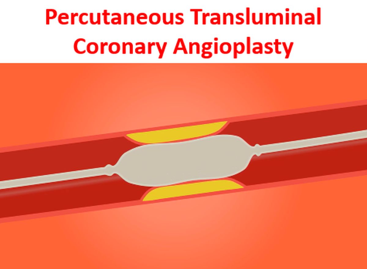 history of percutaneous transluminal coronary angioplasty icd 10