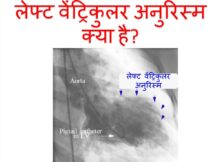 लेफ्ट वेंट्रिकुलर अनुरिस्म क्या है