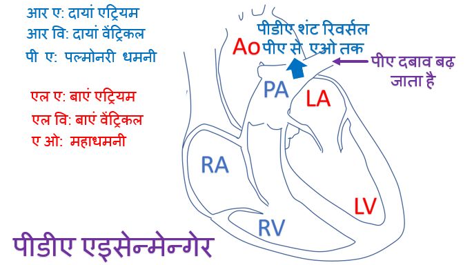पीडीए एइसेन्मेन्गेर