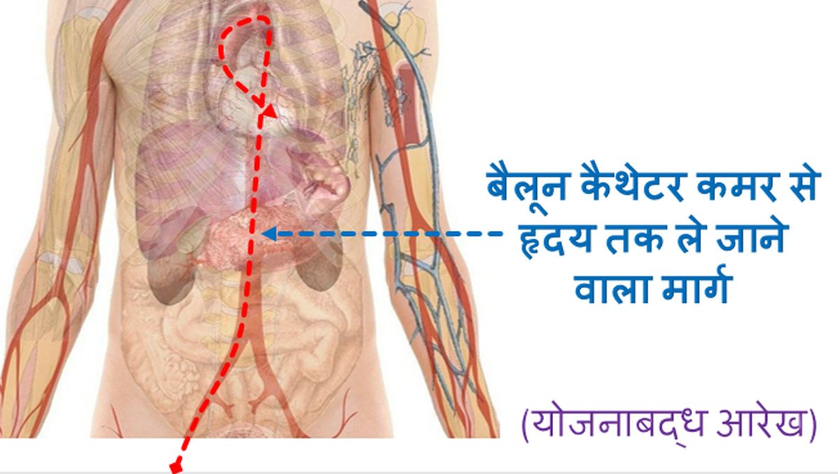 बैलून कैथेटर कमर से हृदय तक ले जाने वाला मार्ग