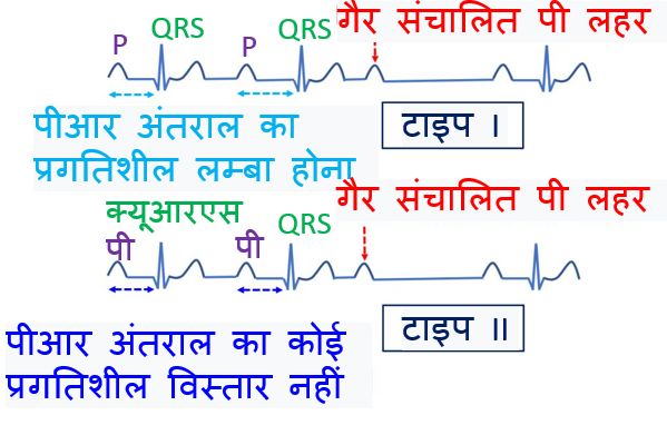 दूसरी डिग्री एवी ब्लॉक - पर मोबीट्ज़ टाइप I और टाइप II