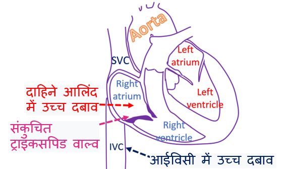 संकुचित ट्राइकसपिड वाल्व में दाहिने आलिंद ओर आईविसी में उच्च दबाव