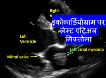इकोकार्डियोग्राम पर लेफ्ट एट्रिअल मिक्सोमा।