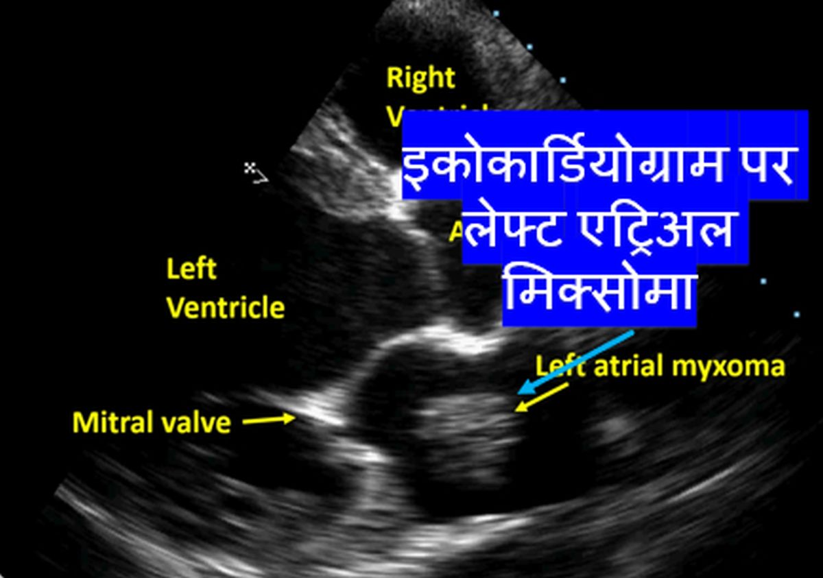 इकोकार्डियोग्राम पर लेफ्ट एट्रिअल मिक्सोमा।