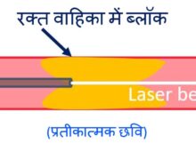 लेजर एंजियोप्लास्टी क्या है