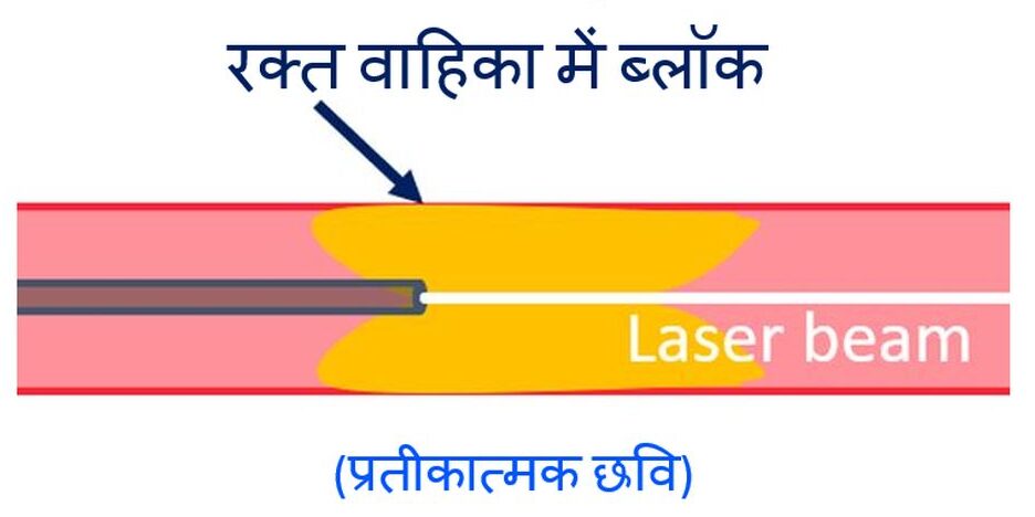 लेजर एंजियोप्लास्टी क्या है