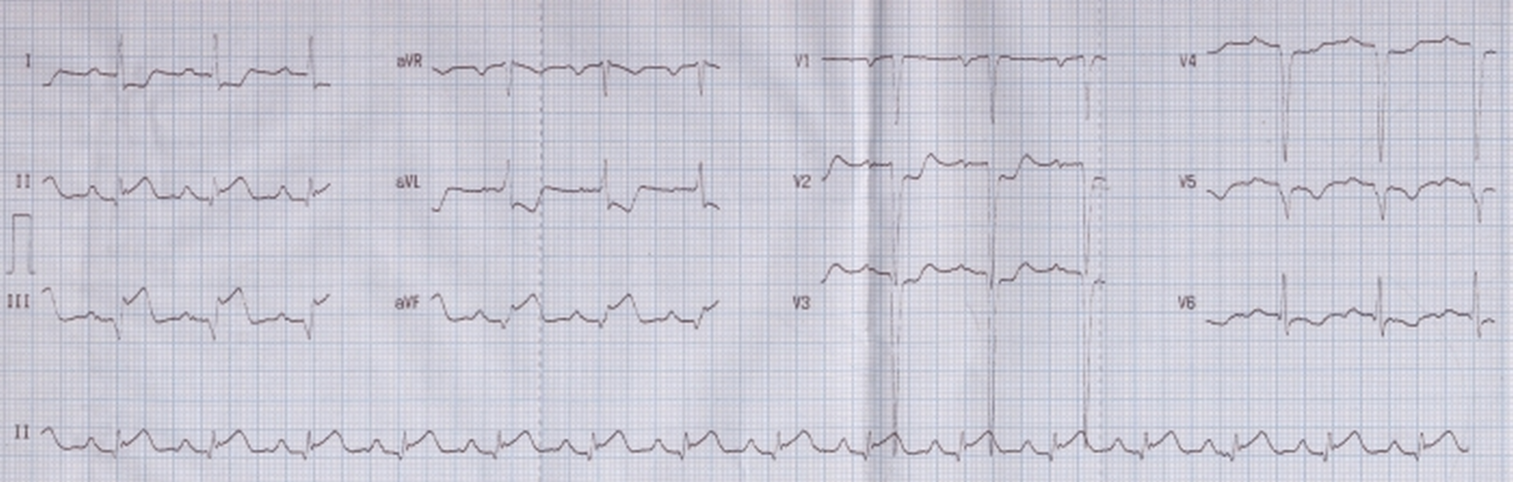 Acute inferior wall inferior wall infarction, old anterior wall infarction and left atrial overload