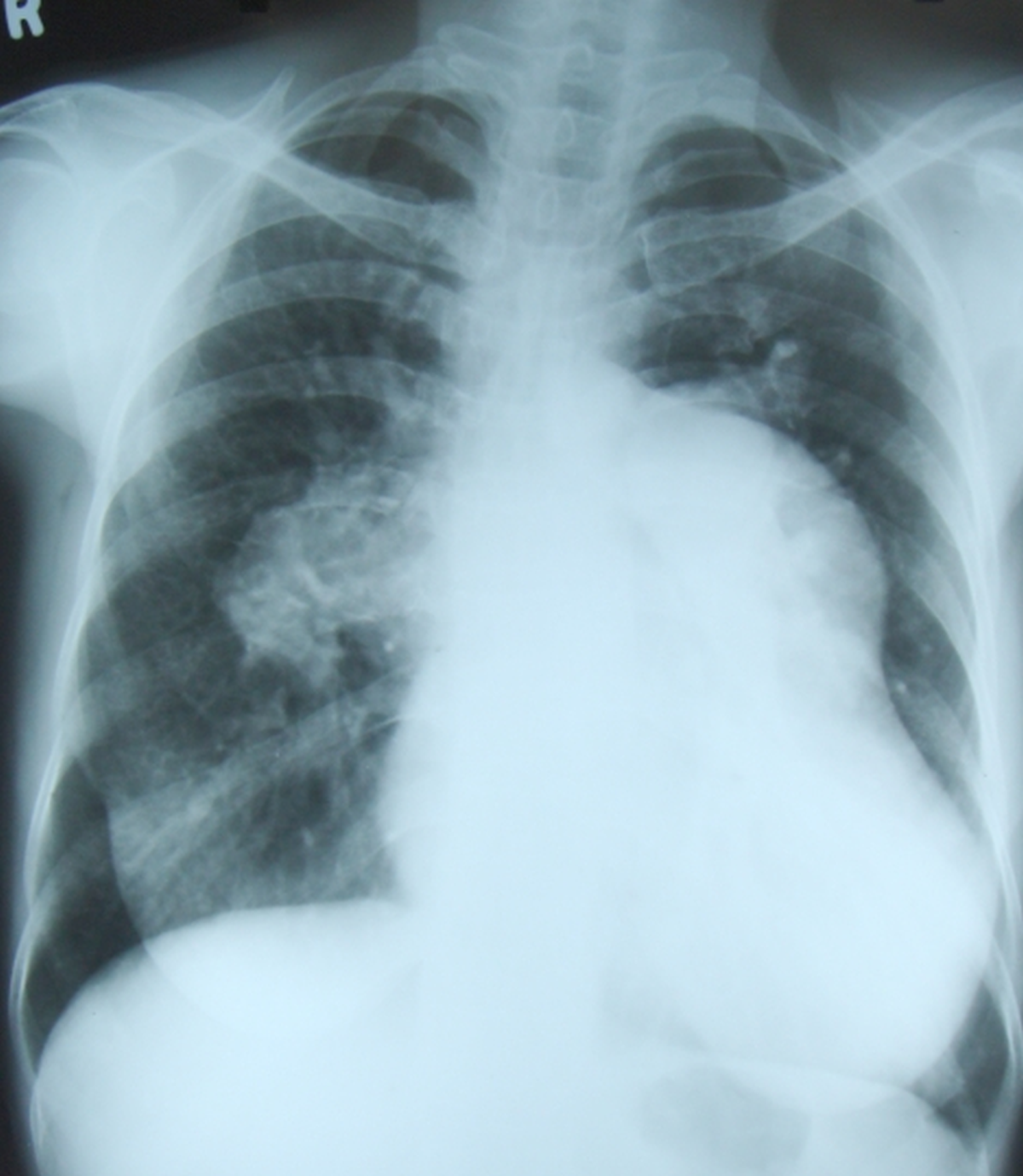 Aneurysmal dilatation of the main pulmonary artery