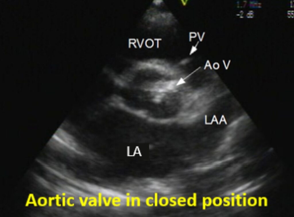 Aortic stenosis: Echocardiogram in parasternal short axis view – All ...