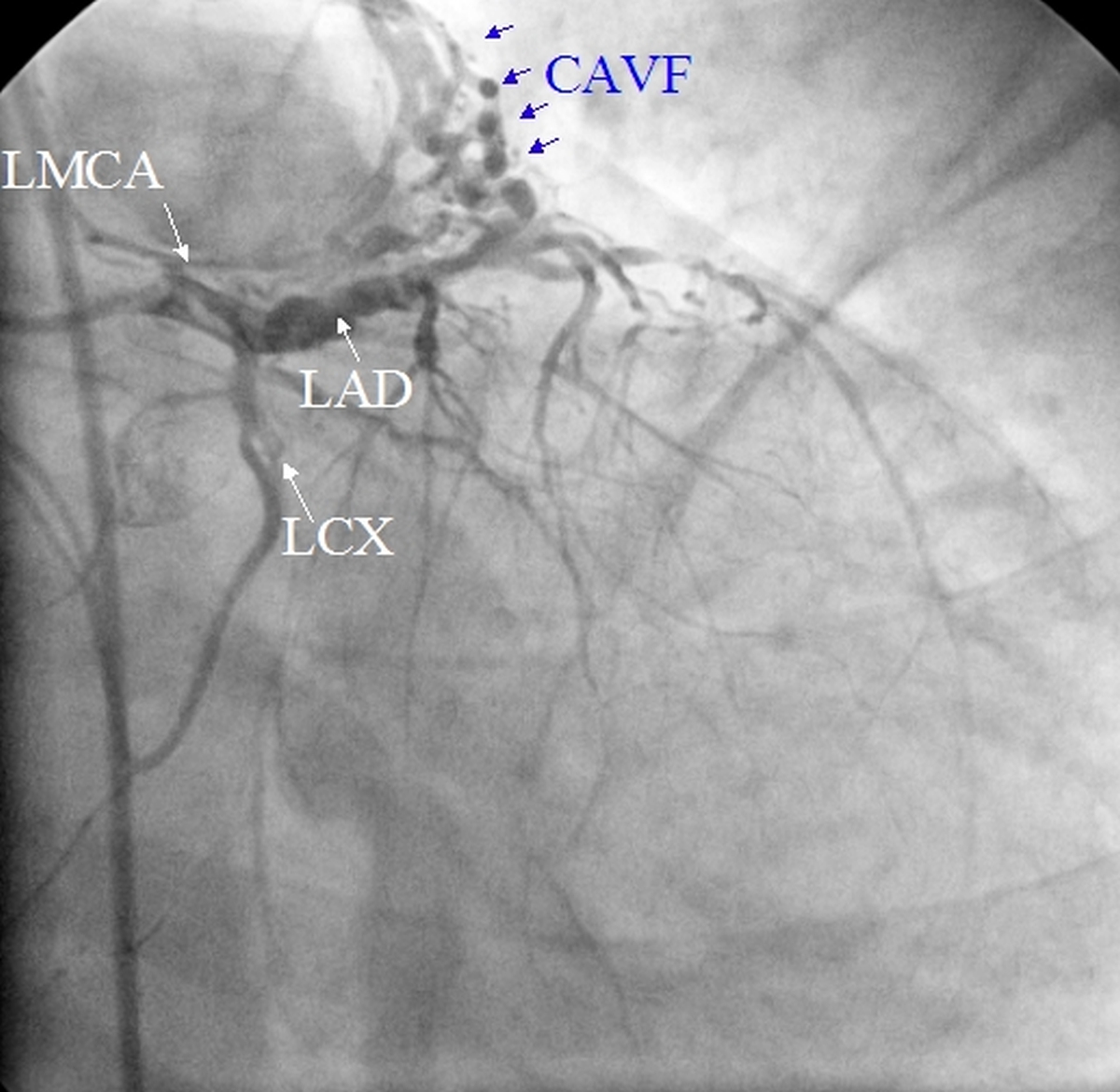 Coronary arteriovenous fistula (CAVF)