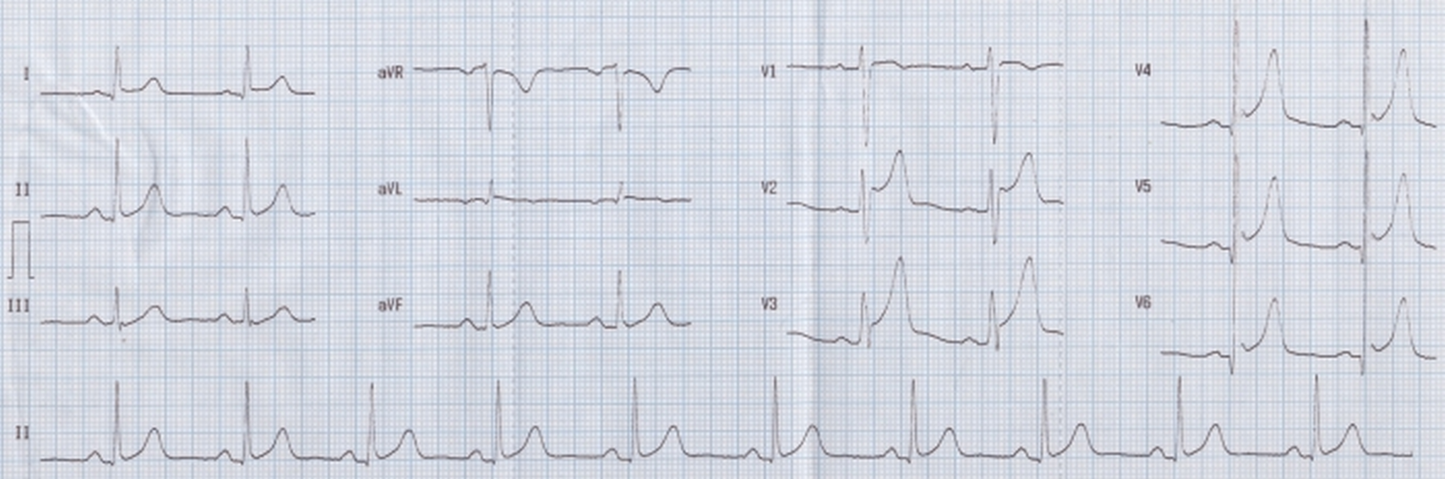 Early repolarization syndrome (ERPS)