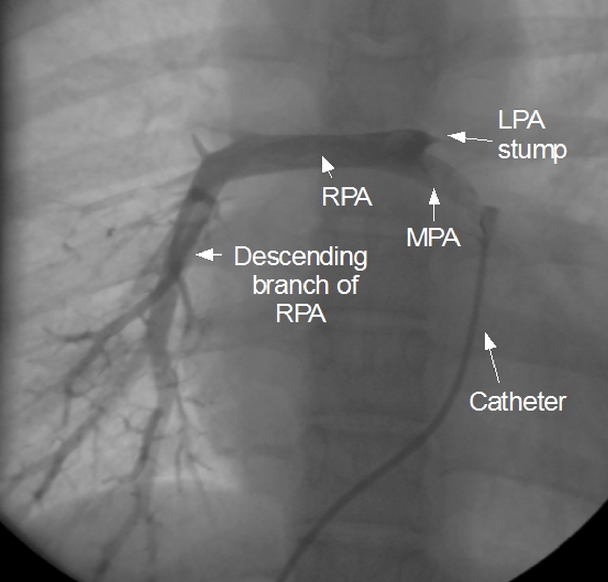 Hypoplastic right pulmonary artery and atretic left pulmonary artery