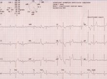 ectopic interpolated ventricular