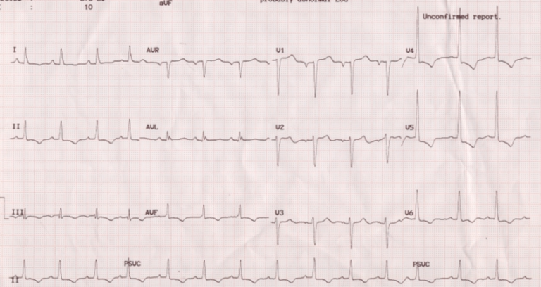 ECG Quiz 8 – All About Cardiovascular System and Disorders