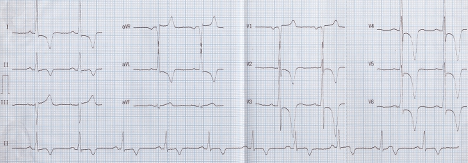 Left ventricular hypertrophy with strain pattern and giant T wave inversion