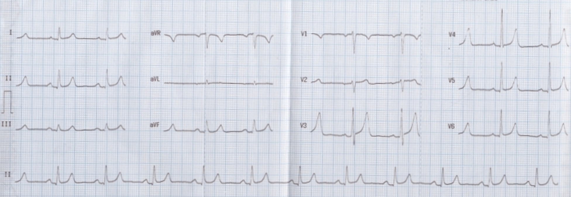 Normal variant ECG with tall T waves