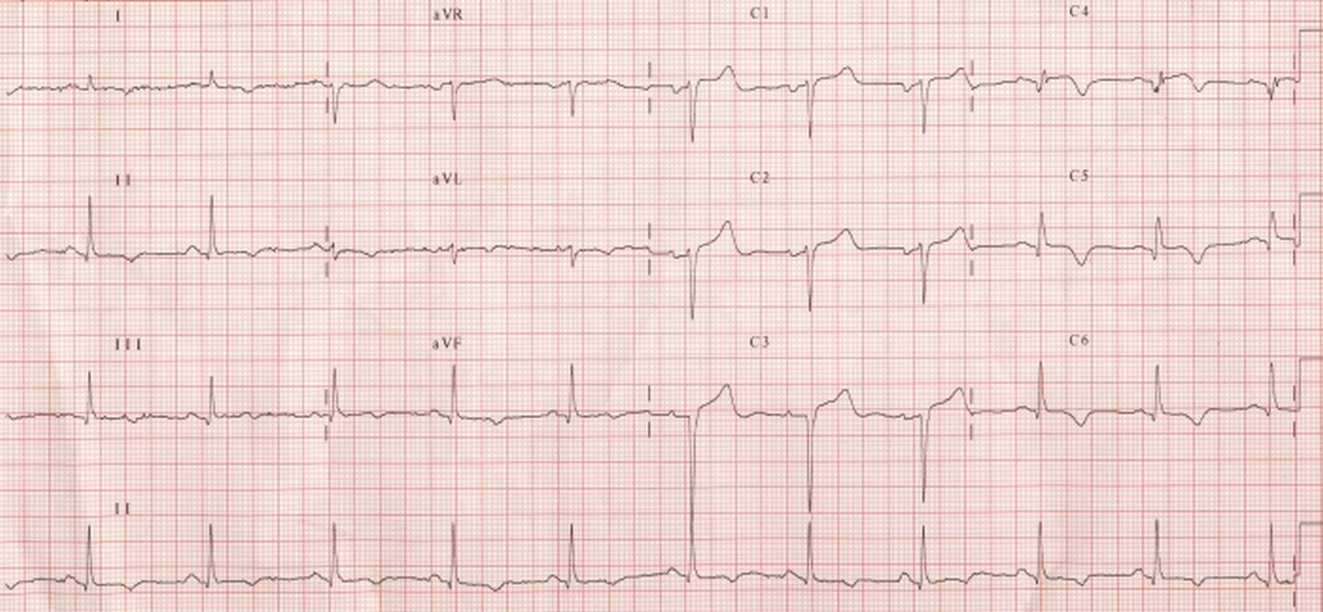 Old anterior wall myocardial infarction and left atrial overload