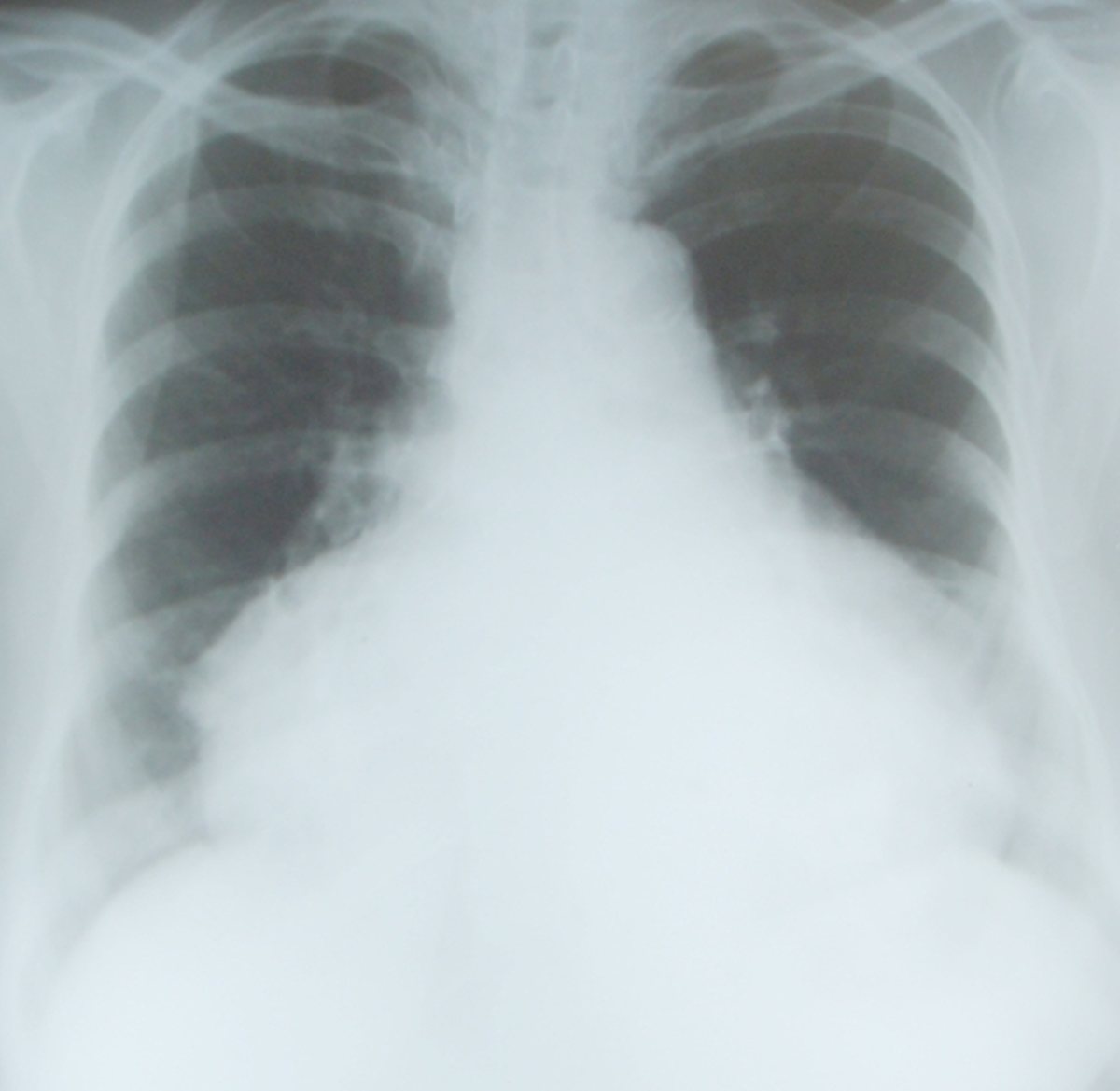 X-ray chest PA with gross cardiomegaly