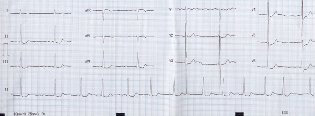 af with fast vr icd 10