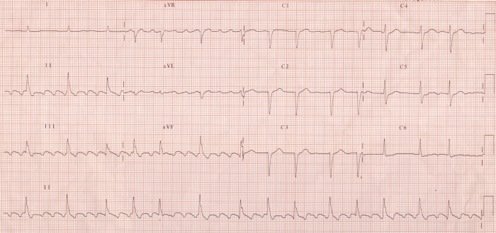 Atrial flutter with varying conduction (4:1 and 3:1)