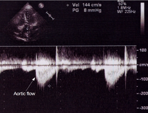 Aortic flow velocity by Doppler echo